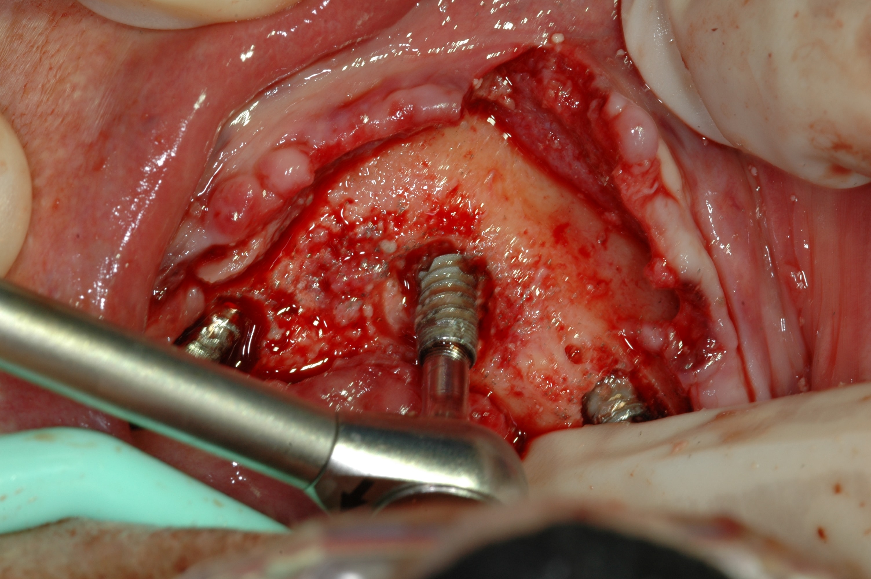 Failing implants showing bone loss