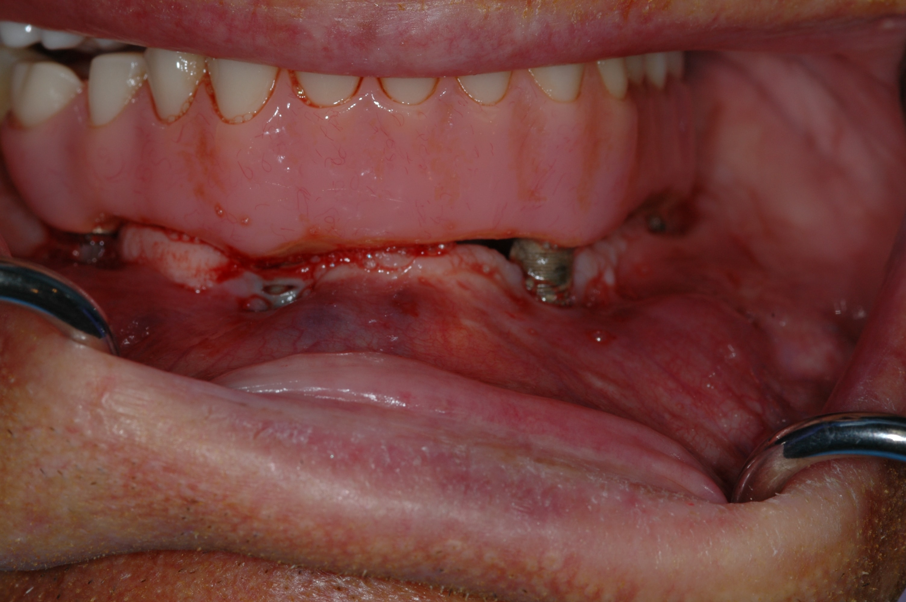 Failing implants under All-on-4 teeth