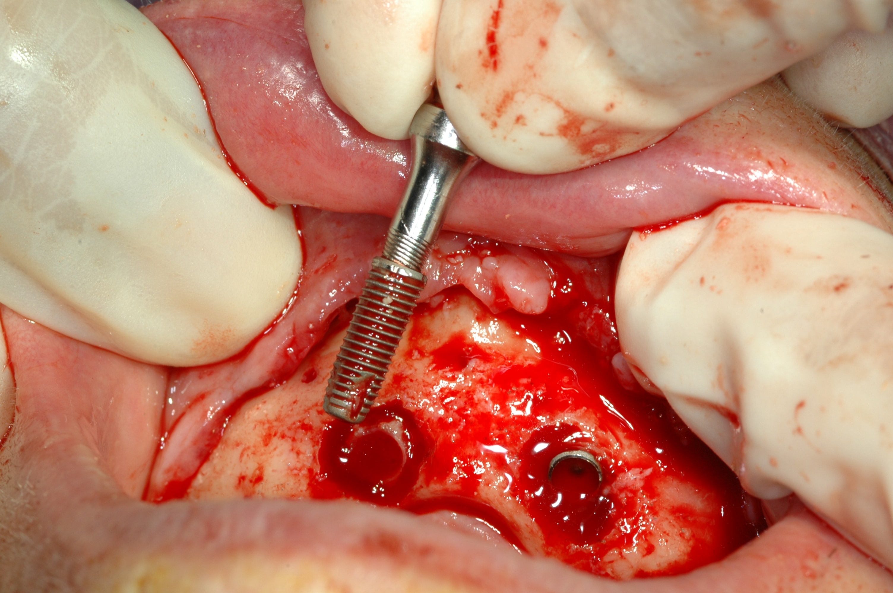 Failed implant removal