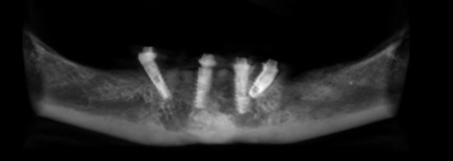 Example of implants placed at wrong angles and close to one another