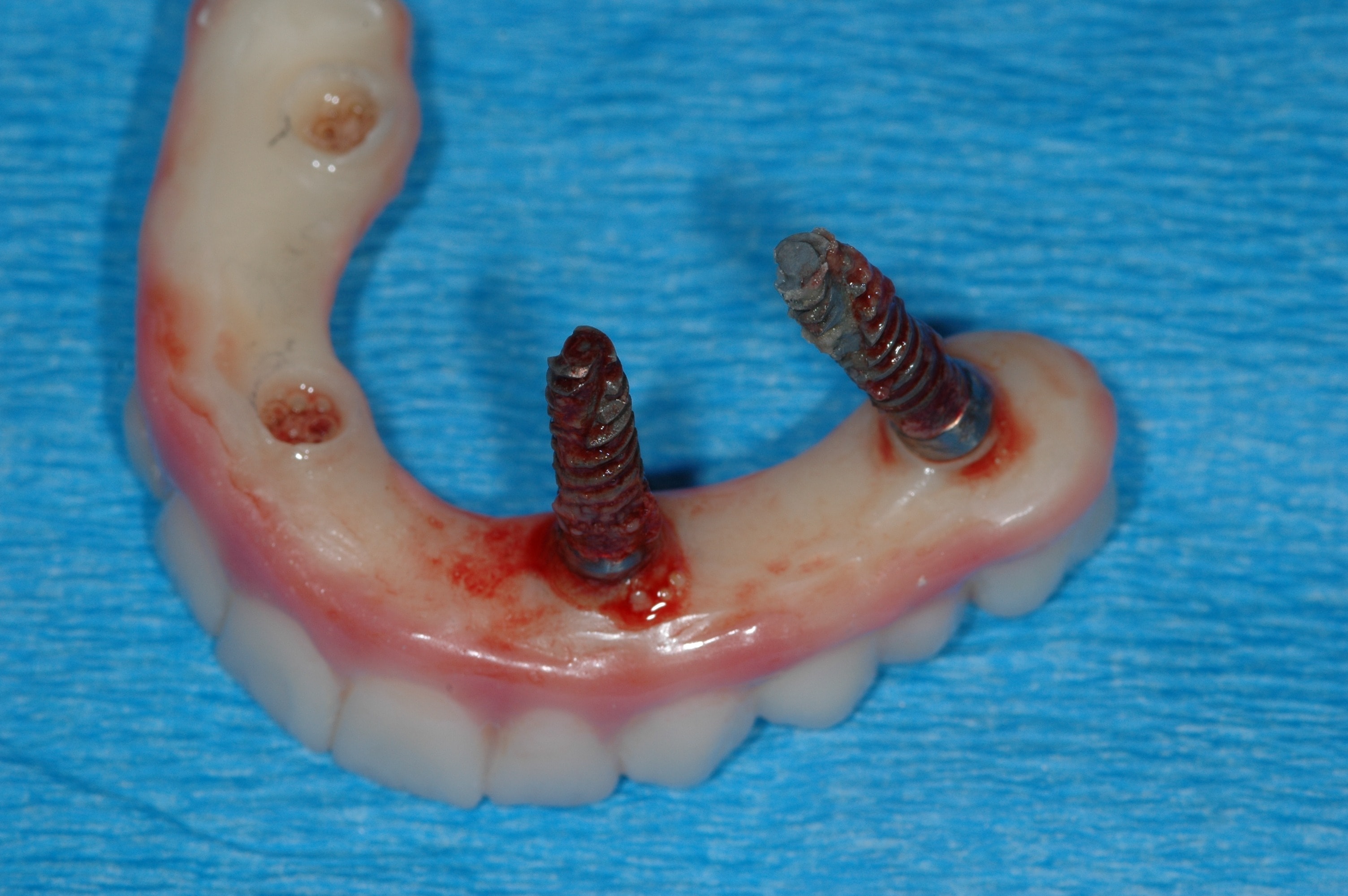All-on-4 teeth came out of patients mouth with loose implants