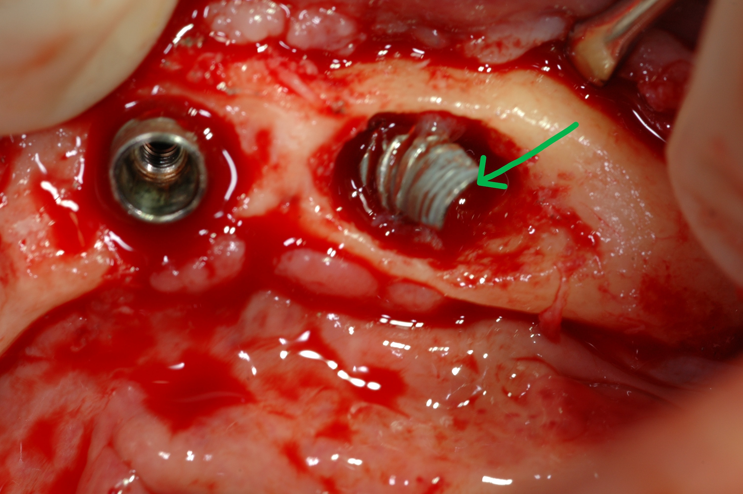 Implant broken inside patient's mouth