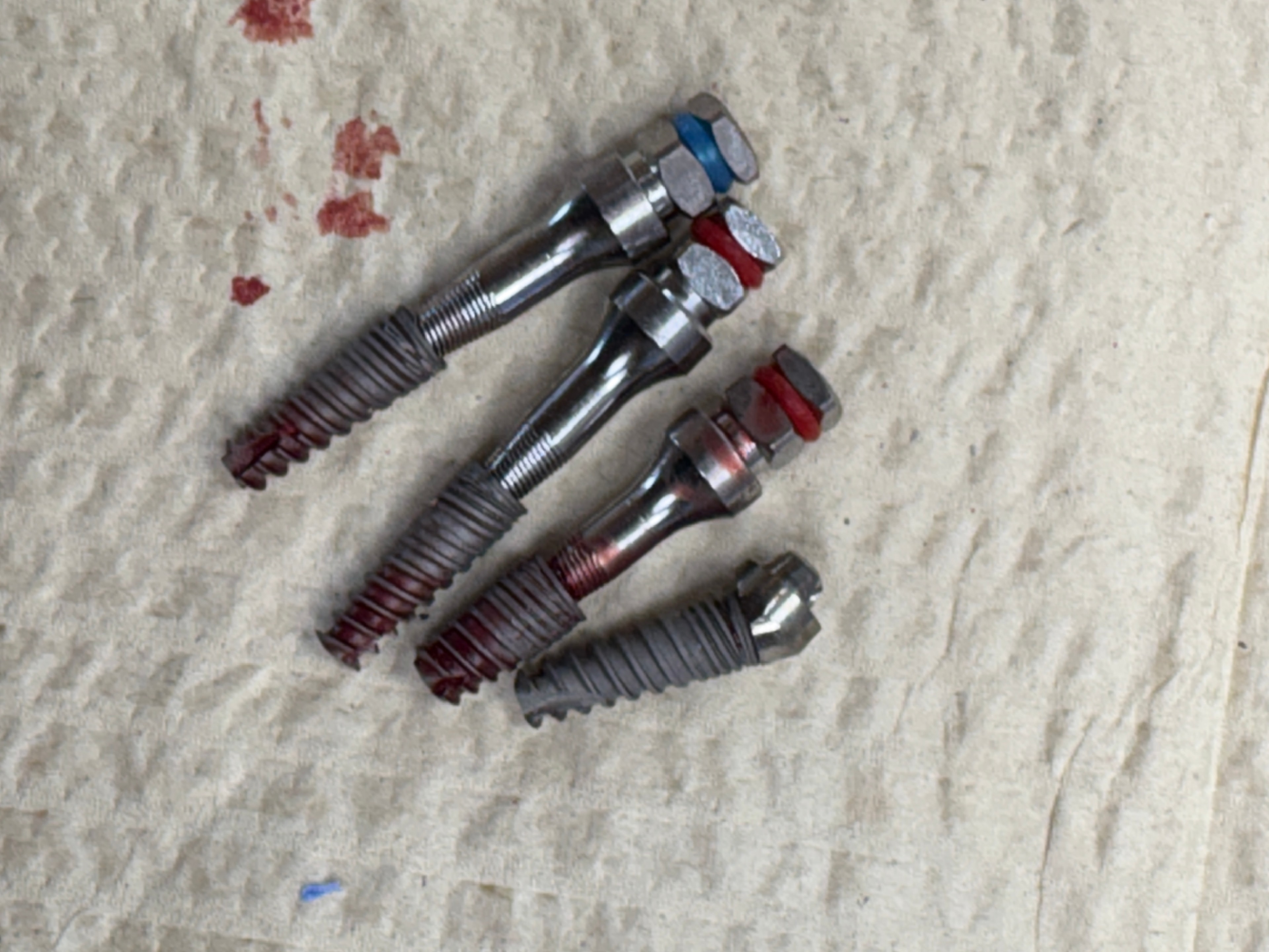 Implants removed due to mobility and no osseointegration
