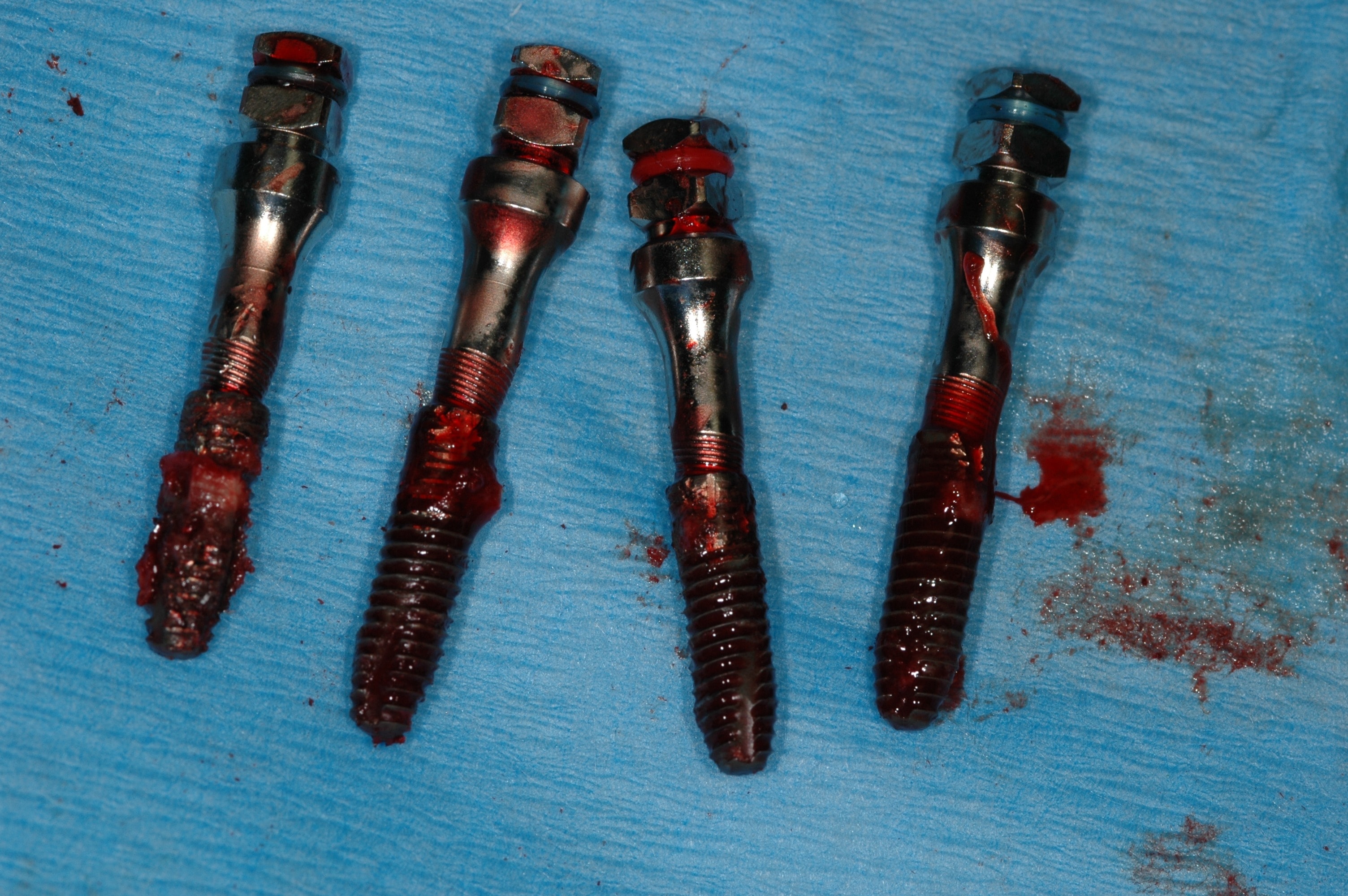 Failed implants removed from patients mouth