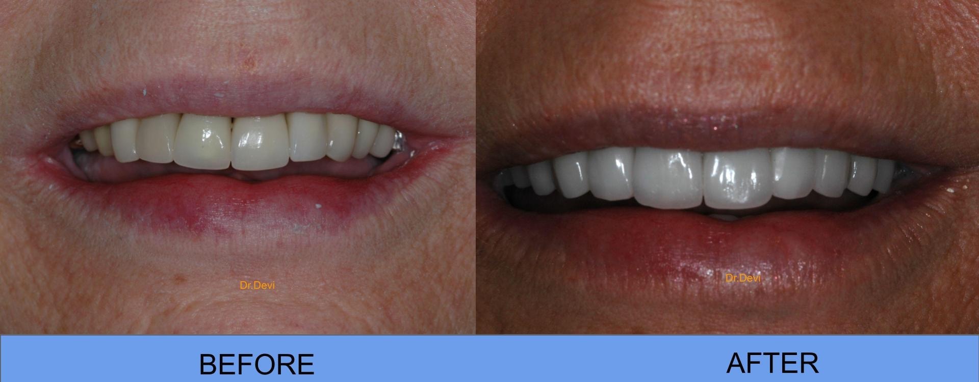 Patient smile transformation