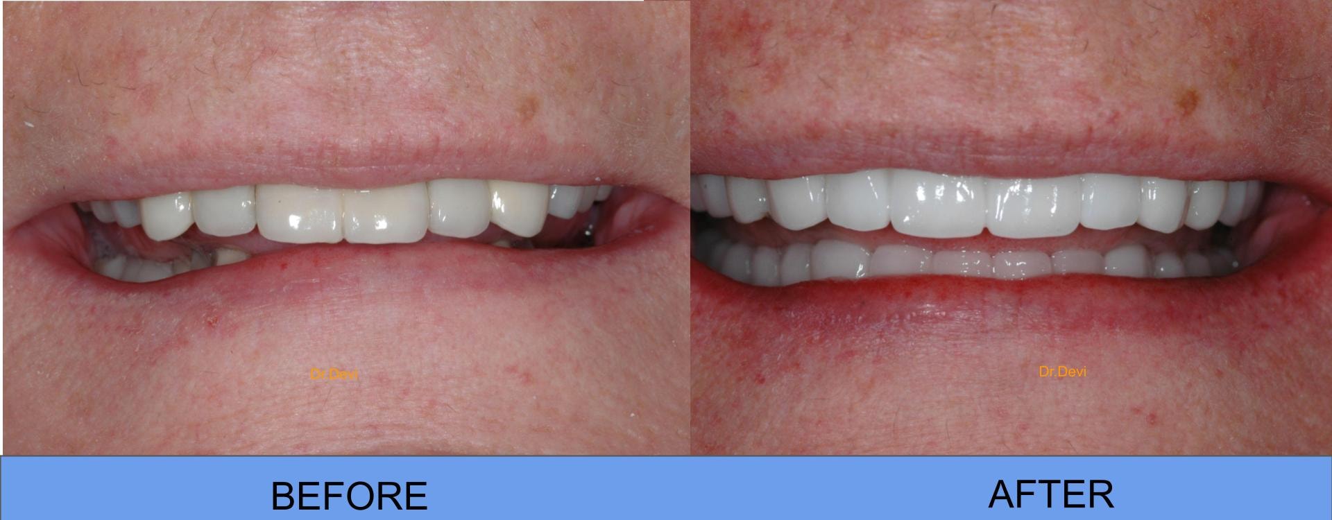 Patient smile transformation