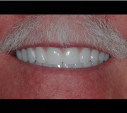 Beautiful Smile after Dental Implant